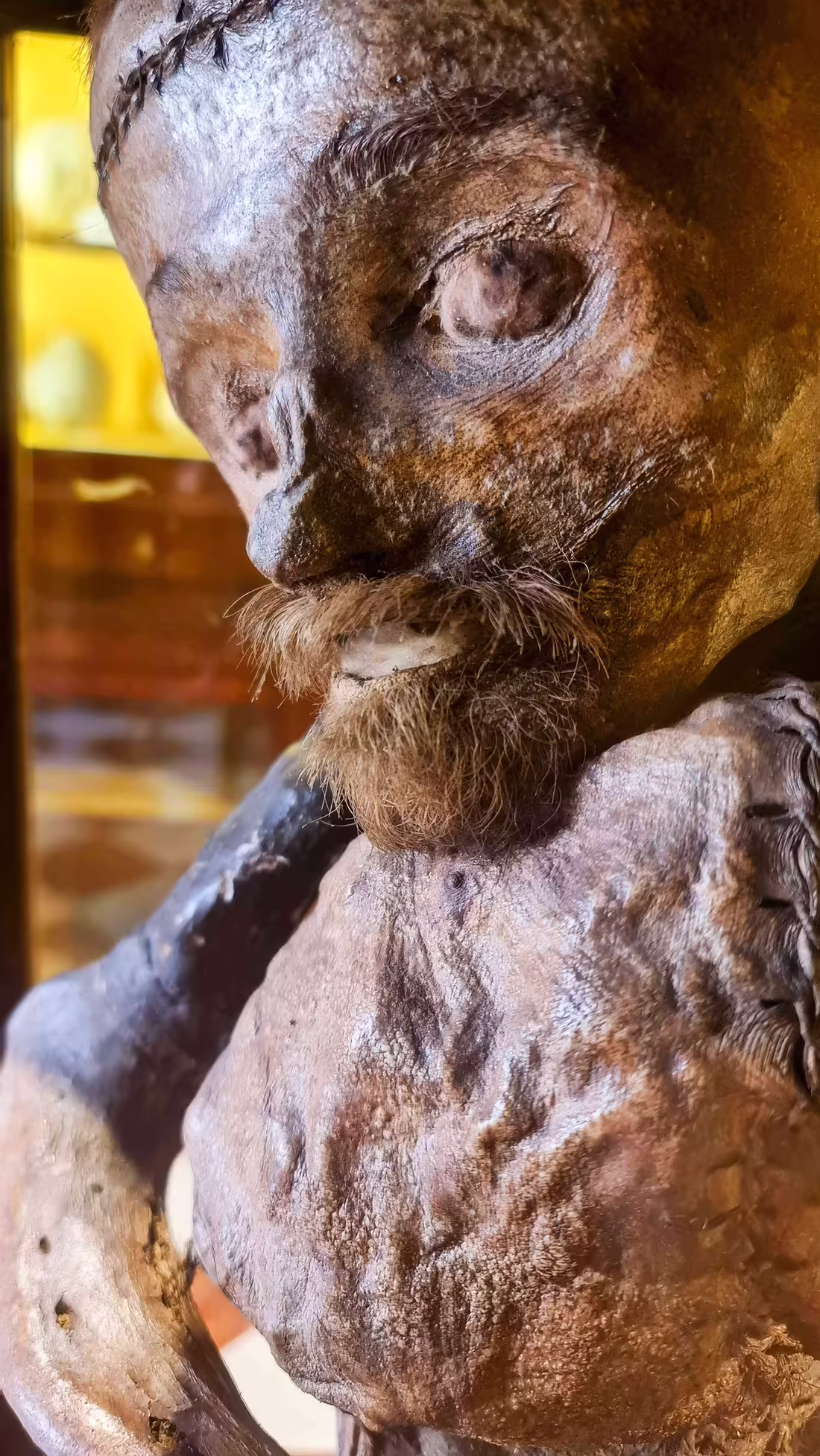 Ss Giovanni e Paolo Hospital - Museum of Pathological Anatomy